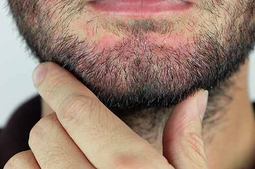 caspa en barba, dermatitis seborreica, caspa, cabello, escamas, picazón, irritación, dermatologia, tratamiento, causas